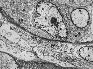 F,76y. | unspecified sarcoma (myocarcoma v.s.) - calf